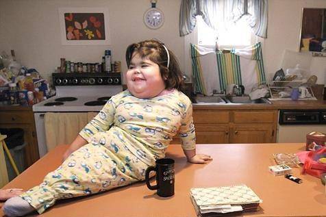 سندروم پری دریایی