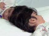 دوقلوی بهم چسبیده