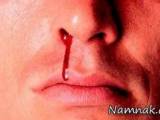 خونریزی بینی 