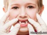 شکستن دندان کودک