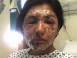 صورت اسید پاشی