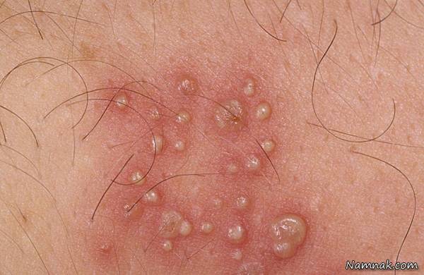 علت هرپس اندام جنسی 