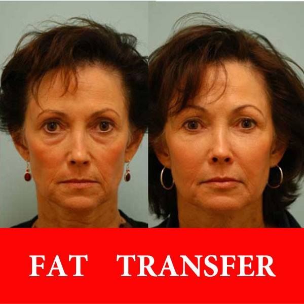 تزریق چربی صورت مزایای تزریق چربی