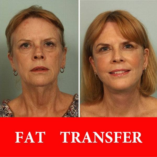 تزریق چربی به صورت تزریق چربی به صورت