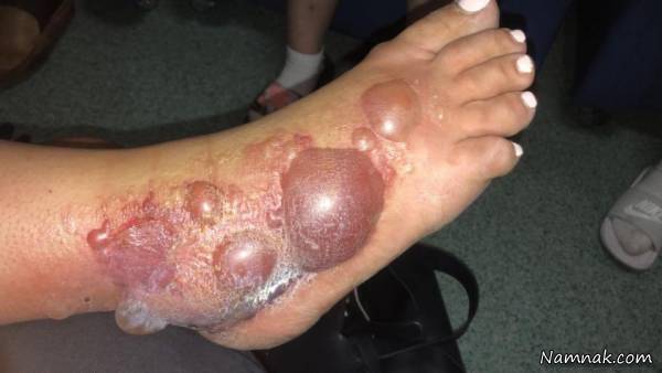 آلودگی خرمگس بیماری خرمگس