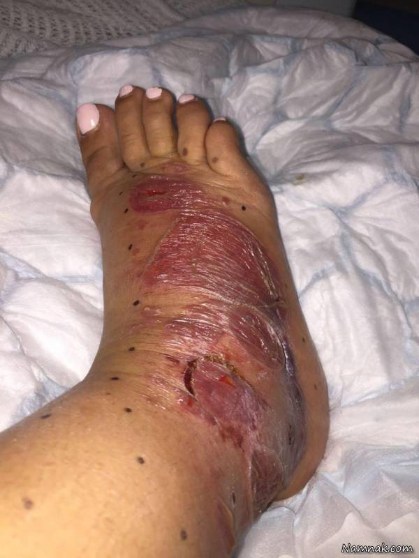 جای نیش خرمگس انواع خرمگس