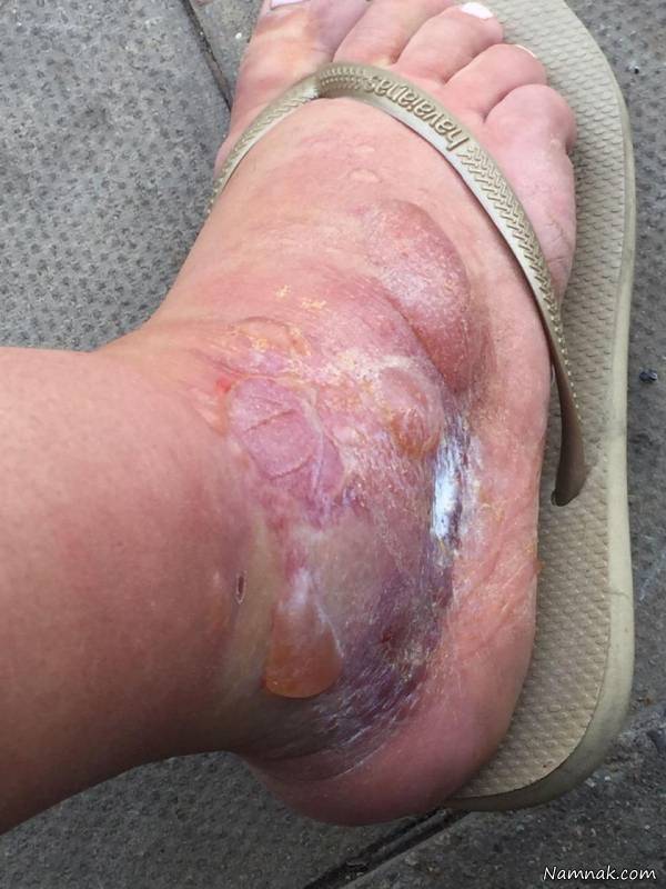 نیش آلوده خرمگس خونخوار خرمگس خونخوار