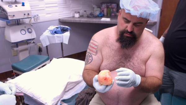 تومور خوش خیم 