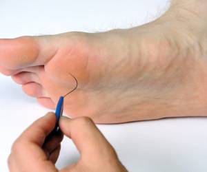 مراقبت از زخم دیابتی