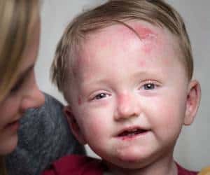 بیماری پروانه ای