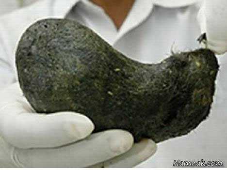 توده مو در معده زن هندی