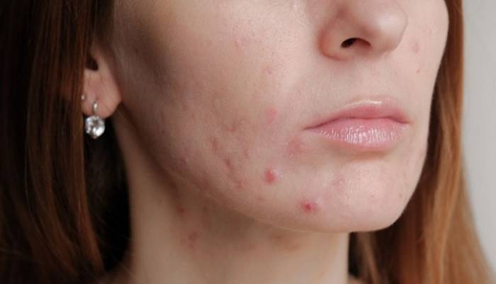 جوش و مشکلات بدن