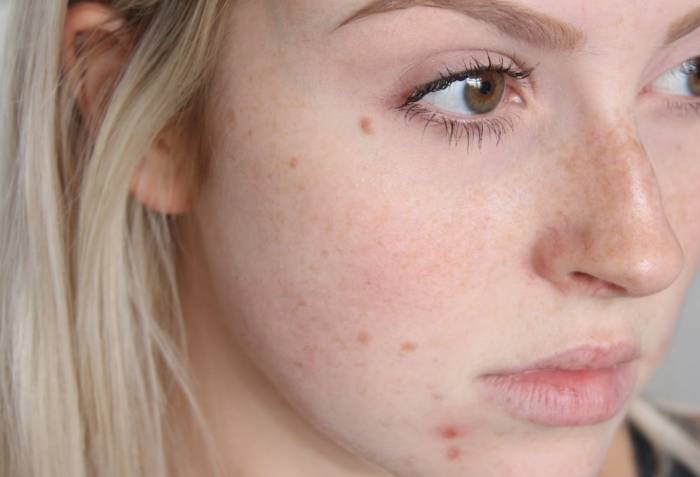 علت جوش پیشانی