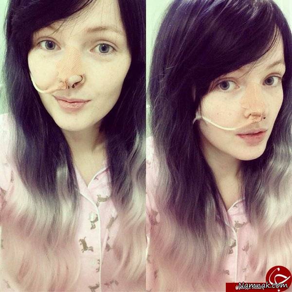 دختری که به سندروم زیبای خفته مبتلا است خواب