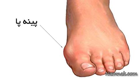 درد پینه پا