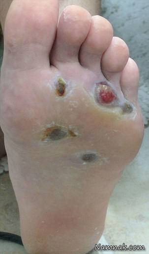 عاقبت پابرهنه راه رفتن پابرهنه راه رفتن