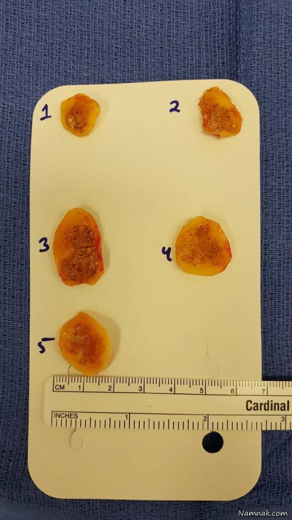 عفونت پا به خاطر پابرهنه راه رفتن پابرهنه راه رفتن