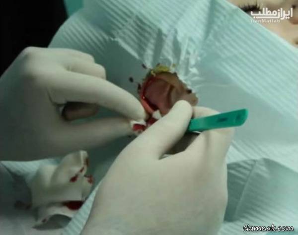 جراحی گوش الاغی