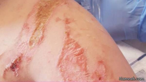 منفجر شدن کتری در کلاس