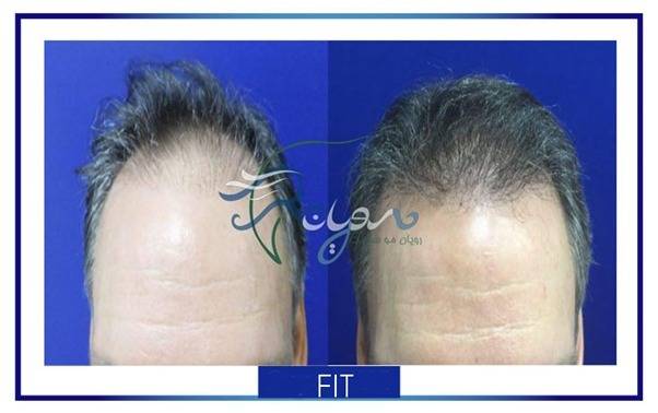 کاشت مو fit