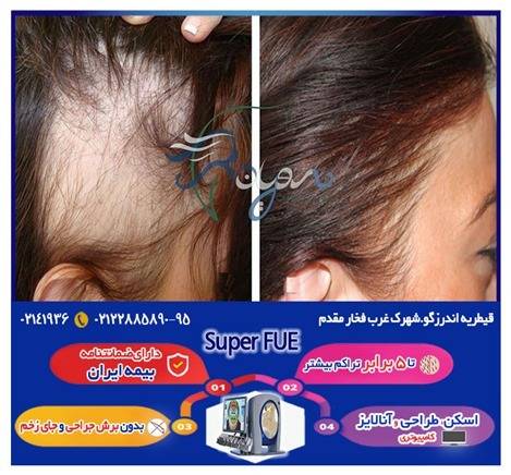 کاشت مو بانوان