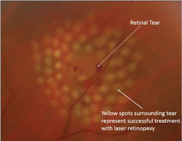 پارگی شبکیه چشم پارگی شبکیه چشم