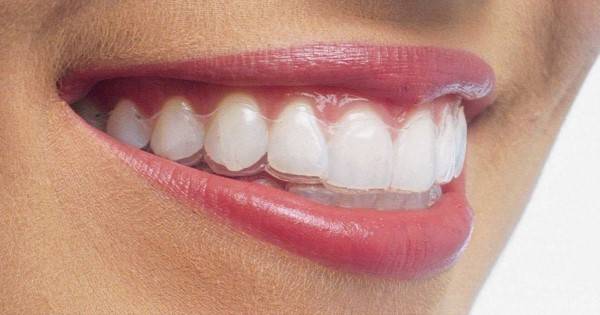 ارتودنسی نامرئی