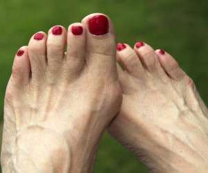 درمان خانگی هالوکس والگوس