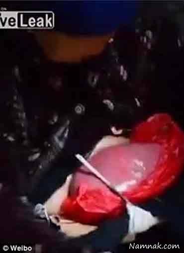 روده خارج از بدن