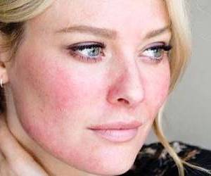 بارداری و لوپوس