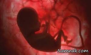 نارسایی قلب جنین