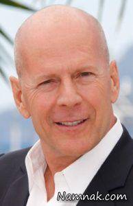 سلبریتی هایی که ریزش مو دارند + تصاویر ریزش مو