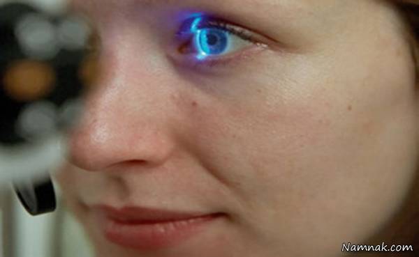 گلوکوم چشم گلوکوم