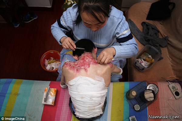 بیماری پوستی می ژیائو پسر چینی بیماری پوستی