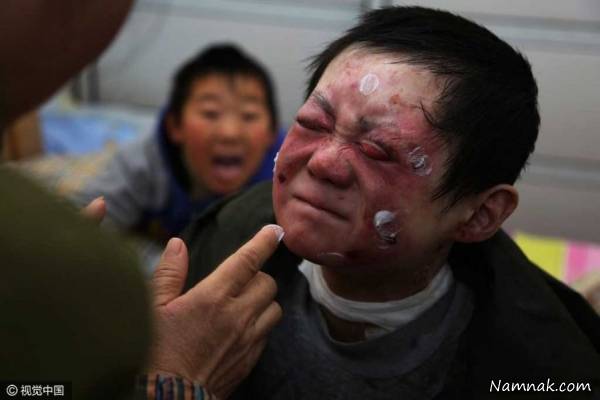 زندگی سخت پسر چینی به دلیل بیماری بیماری پوستی پسر چینی