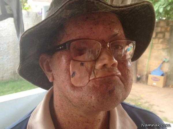 علت بیماری صورت سوخته