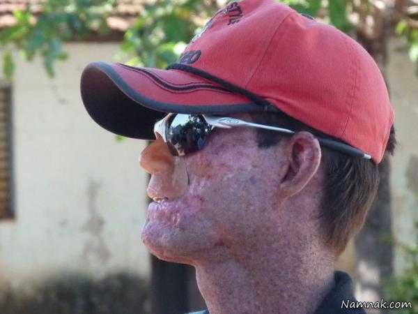 صورت سوخته صورت