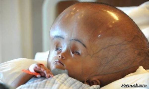 بیماری هیدروسفالی