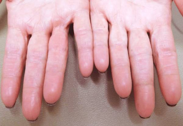 فقدان اثر انگشت