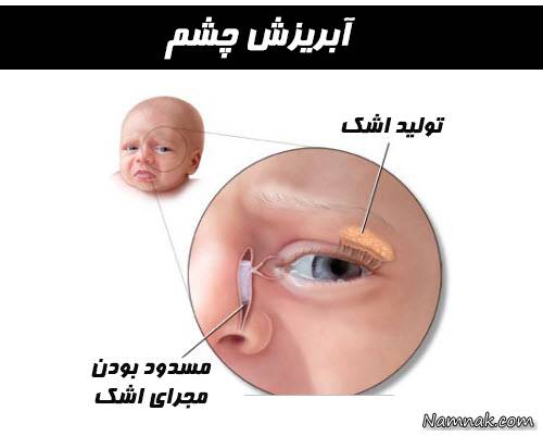 انسداد مجرای اشکی در نوزادان انسداد مجاری اشکی