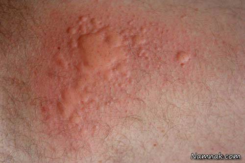 علامت آلرژی غذایی 