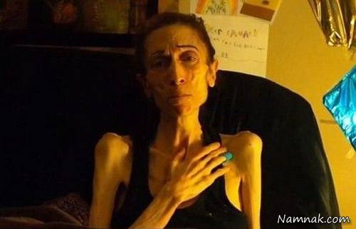 دختر 20 کیلویی 