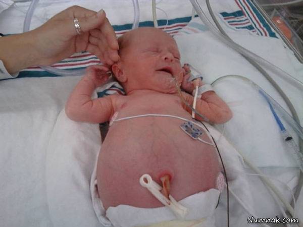 توصیه هایی برای مراقبت ازکودکان مبتلا به هیرشپرونگ مراقبت ازکودکان مبتلا به هیرشپرونگ