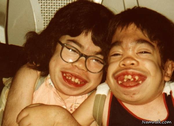 از علت تا درمان بیماری موکوپلی ساکاریدوز بیماری موکوپلی ساکاریدوز