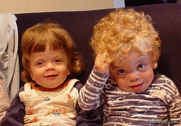 از علت تا درمان بیماری موکوپلی ساکاریدوز بیماری موکوپلی ساکاریدوز