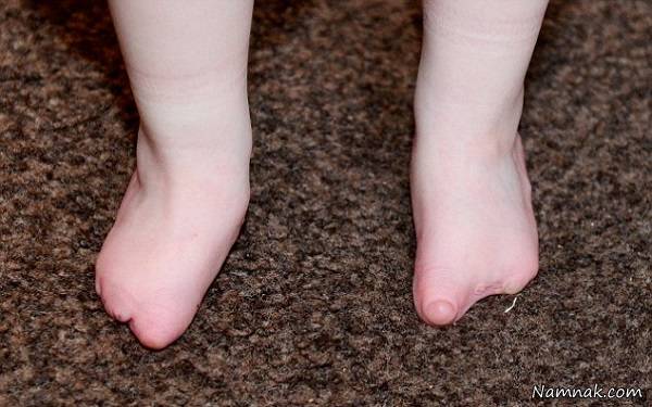 بدون انگشت پا