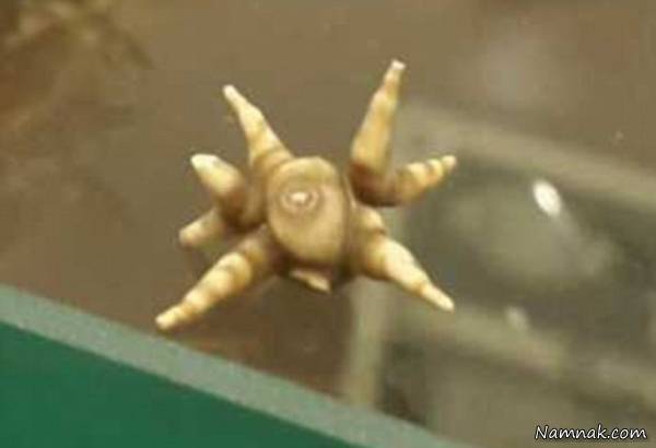 سنگ مثانه عجیب شبیه سنگ فضایی سنگ مثانه