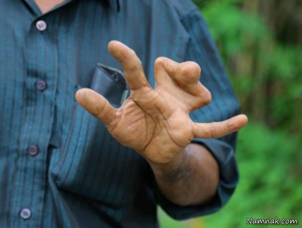 انگشتان چسبیده