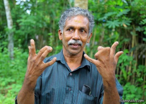 انگشتان چسبیده