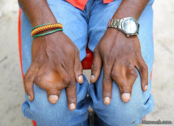 انگشتان چسبیده